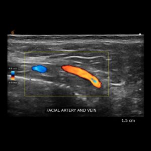 Aesth Facial Artery and Vein L20 HD3 Tablet.jpeg