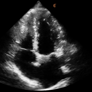 Cardiac CC Apical 4Ch PA HD3 Tablet PNG.png
