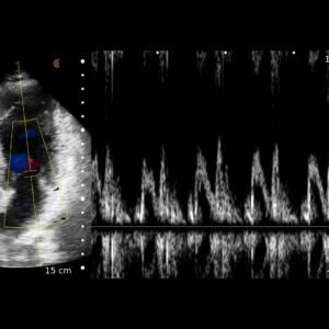 Cardiac CC EMED MV Inflow PA HD3 Tablet 1.jpeg